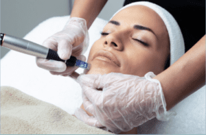 Micro Needling